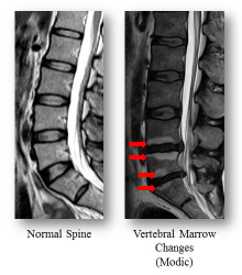 The left MRI photo shows the normal spine without Modic changes; Red arrows on the right photo show Modic changes in the spine. Through different patterns and levels of Modic changes, low back pain development and severity can be diagnosed.